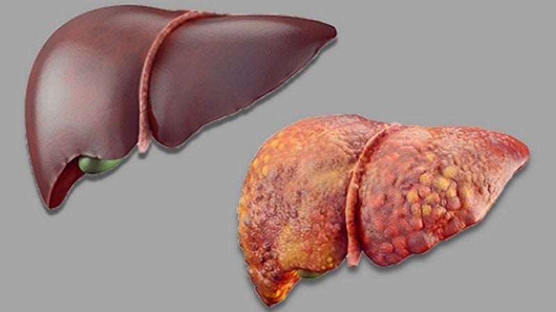 photo of a healthy and a diseased liver