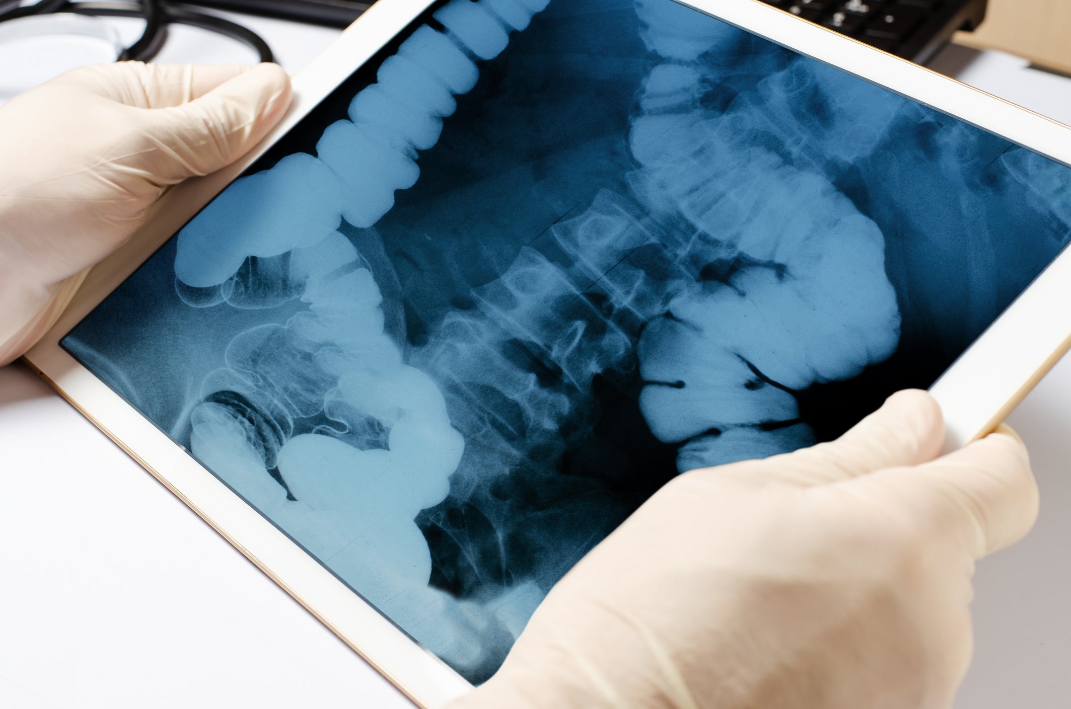 X-ray image of the intestine on a tablet.